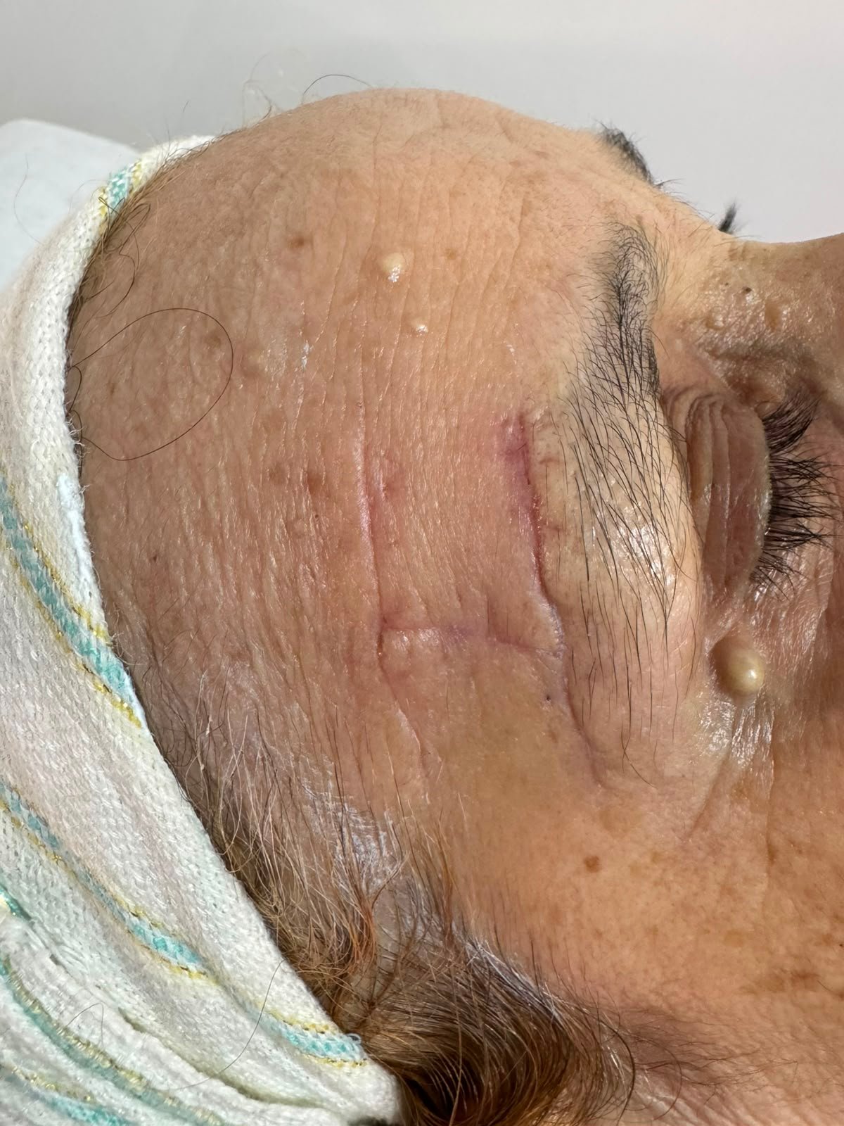 Chirurgie dermatologique Casablanca