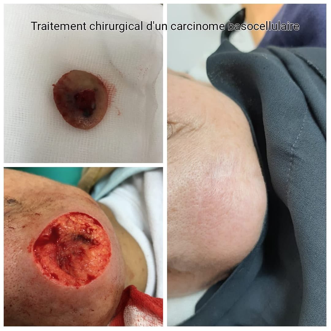 Chirurgie cancérologique dermatologique Casablanca