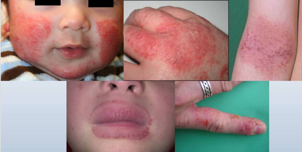 Dermatologie pédiatrique Casablanca